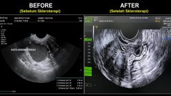 Pertama di NTT! RSU Siloam Kupang Hadirkan Sclerotherapy, Solusi Kista Ovarium Tanpa Operasi