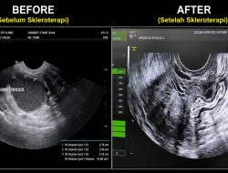 Pertama di NTT! RSU Siloam Kupang Hadirkan Sclerotherapy, Solusi Kista Ovarium Tanpa Operasi
