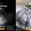 Pertama di NTT! RSU Siloam Kupang Hadirkan Sclerotherapy, Solusi Kista Ovarium Tanpa Operasi