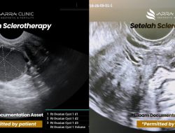Pertama di NTT! RSU Siloam Kupang Hadirkan Sclerotherapy, Solusi Kista Ovarium Tanpa Operasi